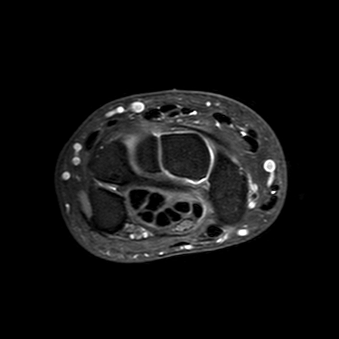 Normal wrist MRI | Image | Radiopaedia.org