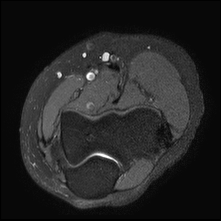 Normal elbow MRI | Image | Radiopaedia.org