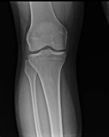 Patellar tendinosis | Radiology Case | Radiopaedia.org