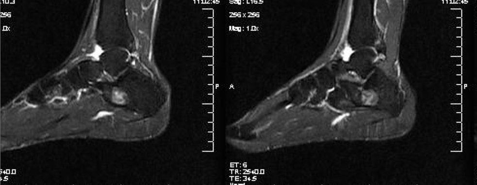 Calcaneal lipoma | Image | Radiopaedia.org