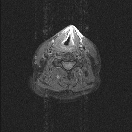 Solitary plasmacytoma | Image | Radiopaedia.org