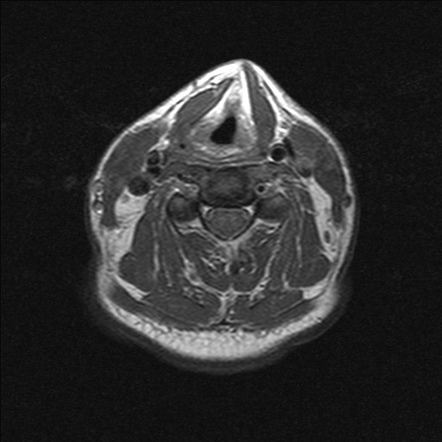 Solitary plasmacytoma | Image | Radiopaedia.org