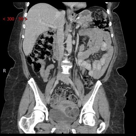 Uterine lipoleiomyoma | Radiology Reference Article | Radiopaedia.org