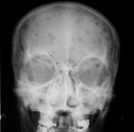 Raindrop skull | Radiology Reference Article | Radiopaedia.org