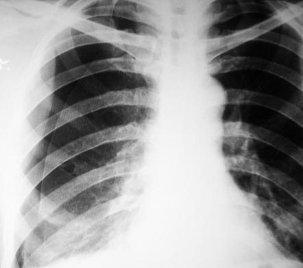 Viewing playlist: Pneumothorax | Radiopaedia.org