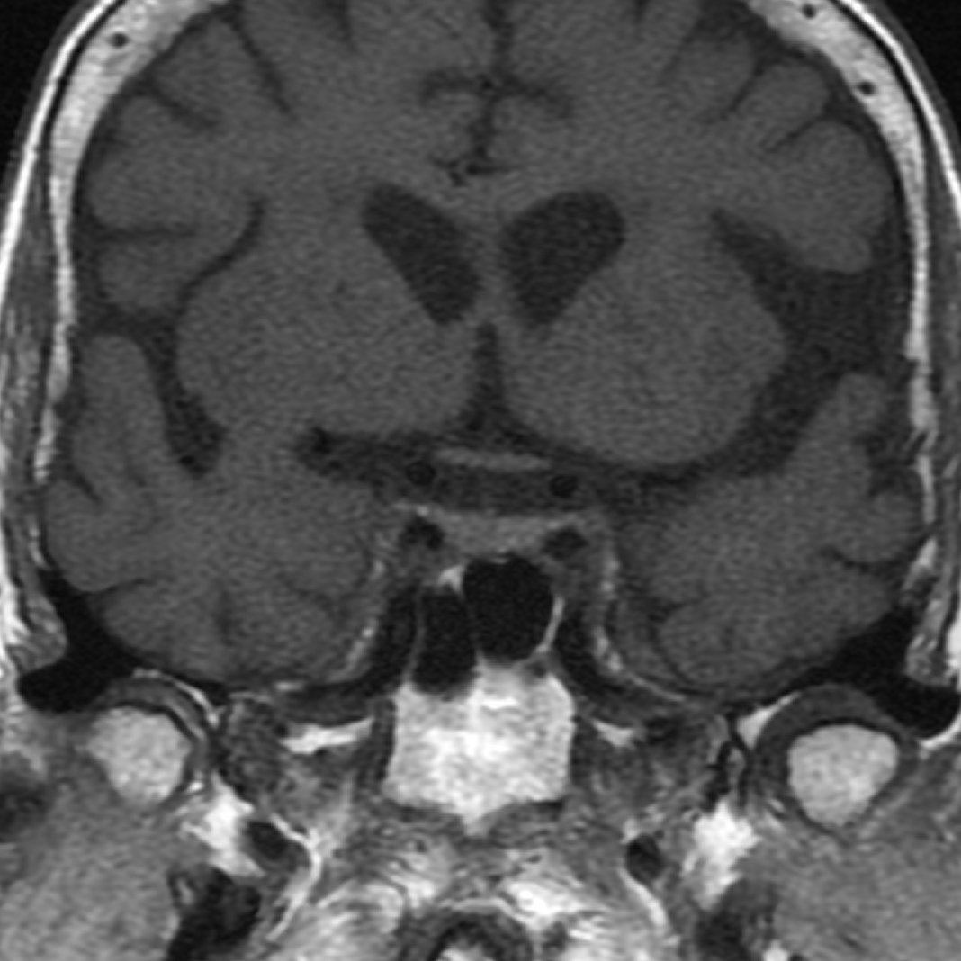 Inferior petrosal sinus sampling | Image | Radiopaedia.org