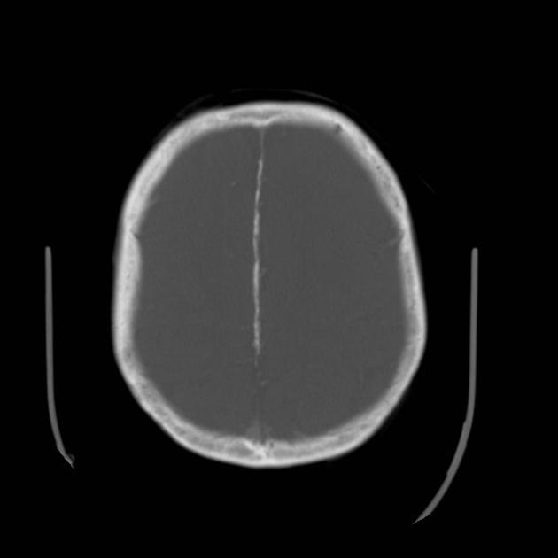 gorlin syndrome