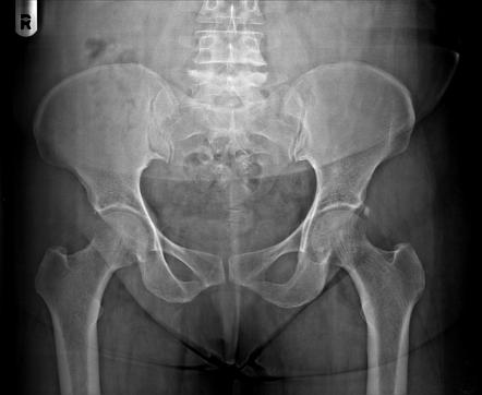 Lipoma - gluteal lesion | Radiology Case | Radiopaedia.org