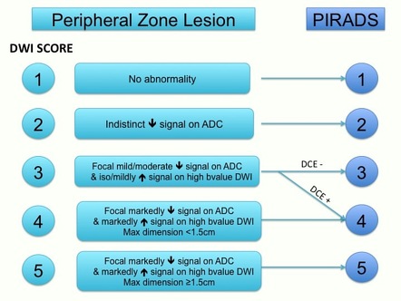 PI-RADS flowchart | Image | Radiopaedia.org