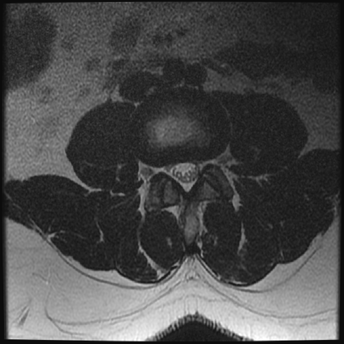 Normal lumbar spine MRI | Image | Radiopaedia.org