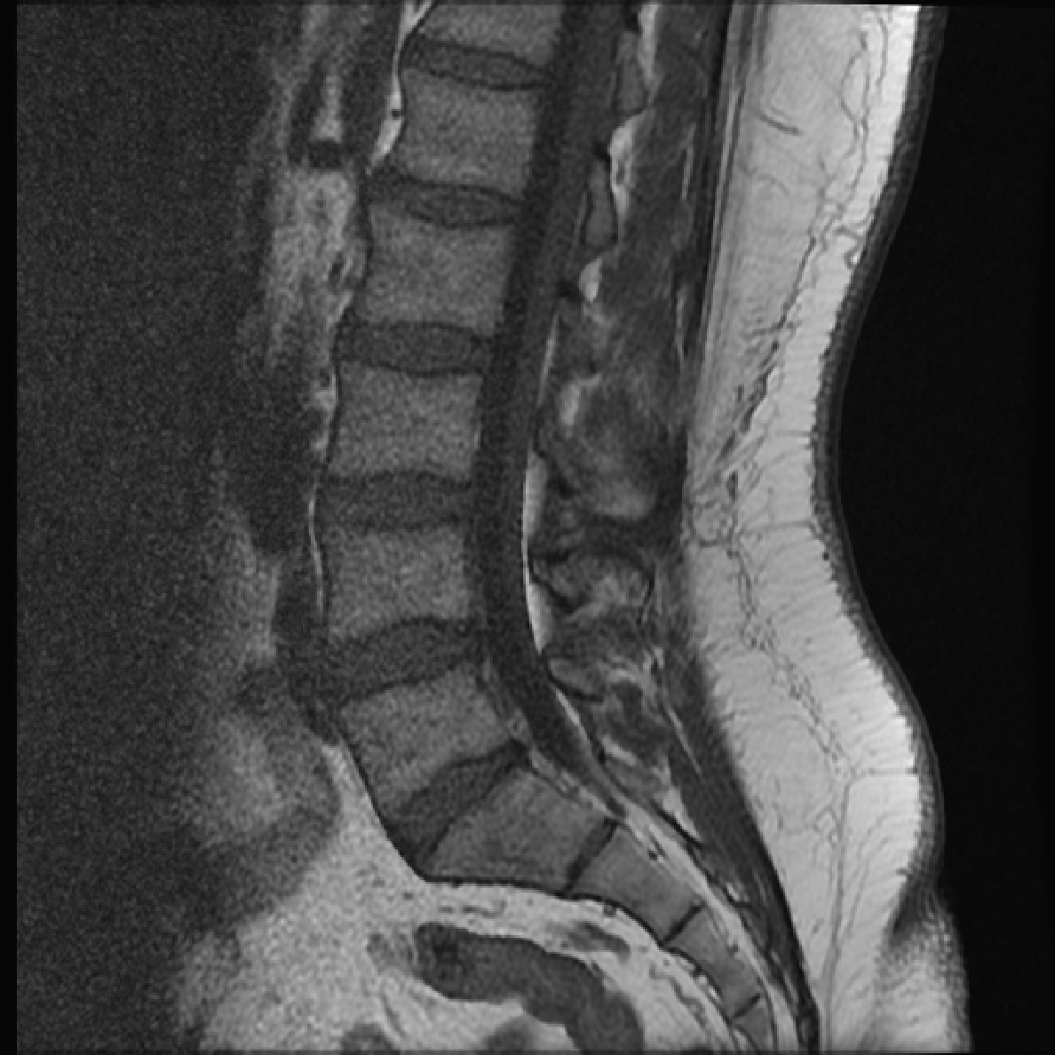 Дискогенная пояснично крестцовая радикулопатия тест. T1 t2 мрт. T Spine мрт. T1 t2-BN Stir поясничный. T1 FS мрт.