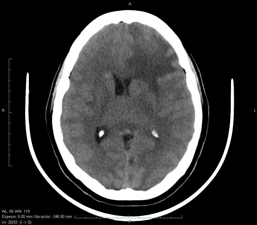 Cerebral metastases | Image | Radiopaedia.org