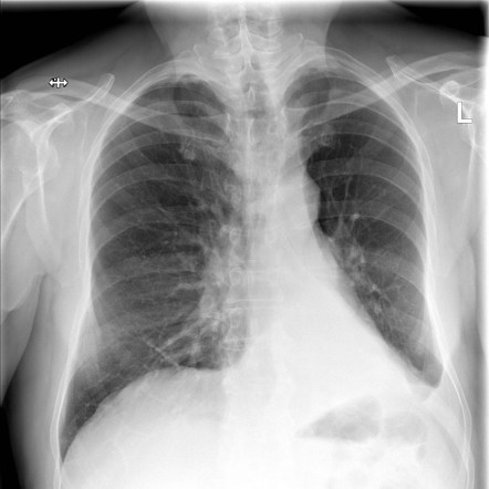 Left lower lobe collapse | Radiology Case | Radiopaedia.org