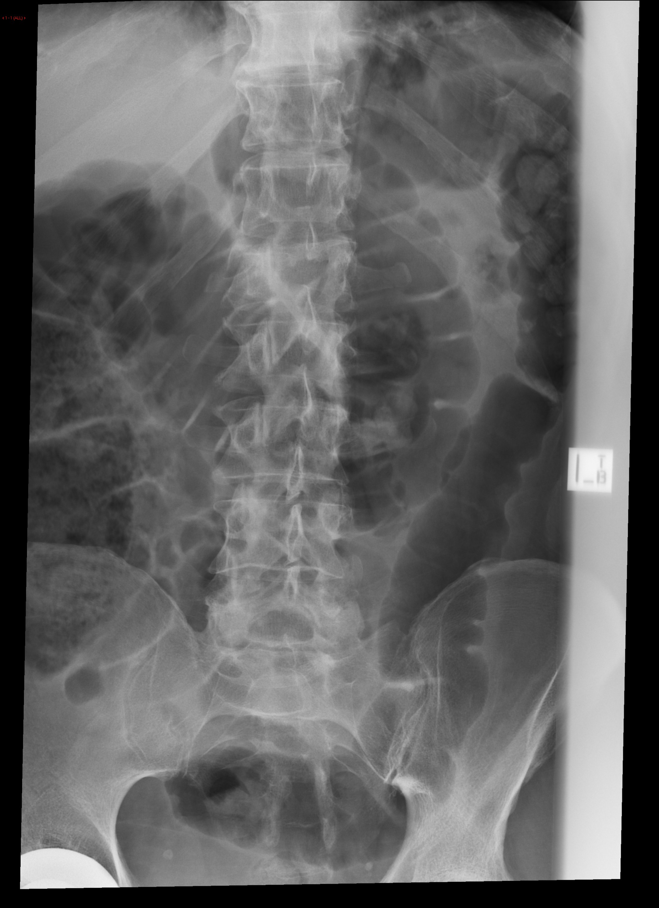 Calcaneal fracture and associated spinal injury | Image | Radiopaedia.org