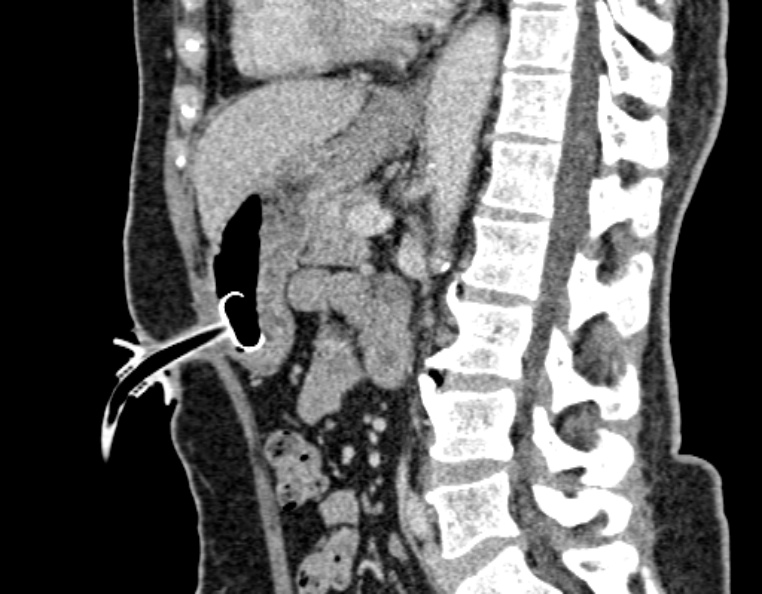 PEG tube | Image | Radiopaedia.org