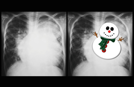 Snowman sign (total anomalous pulmonary venous return) | Radiology ...