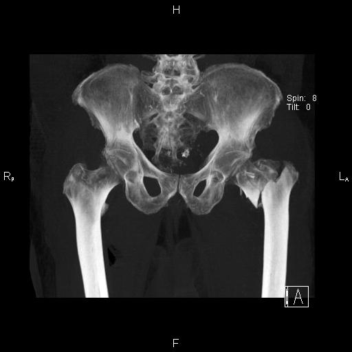 Femoral inter-trochanteric fracture - displaced | Image | Radiopaedia.org