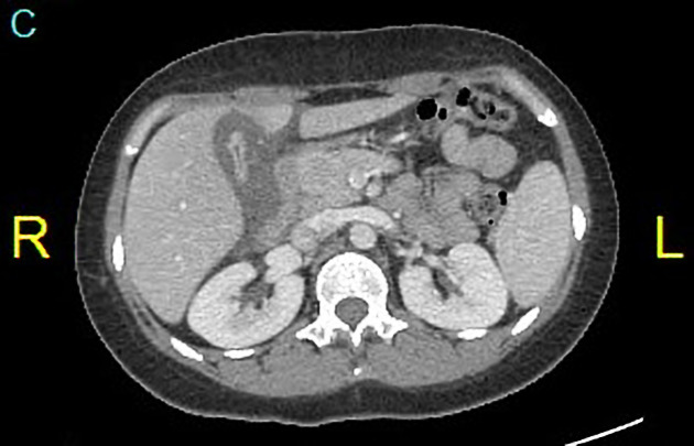 Acute hepatitis, Radiology Reference Article