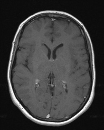 CSF Rhinorrhea From Encephalocoele Secondary To Pseudotumor Cerebri ...