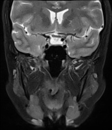 CSF rhinorrhoea from encephalocolele secondary to pseudotumour cerebri ...