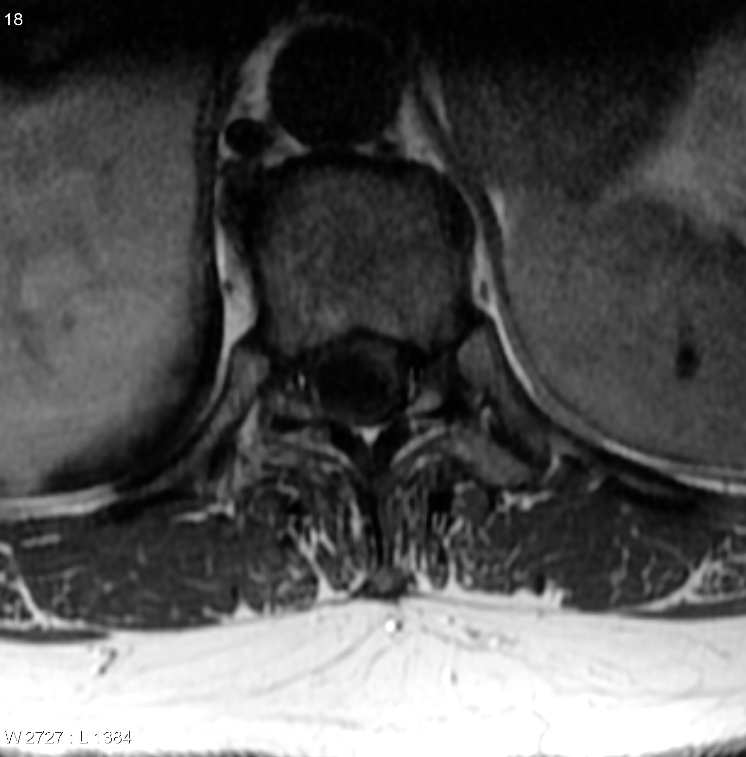 Spinal Schwannoma - Thoracic 