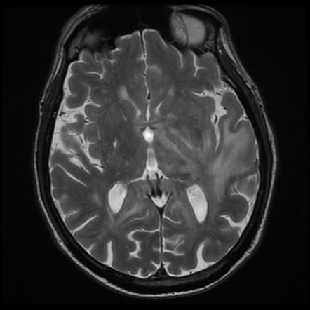 Lymphomatosis cerebri | Image | Radiopaedia.org