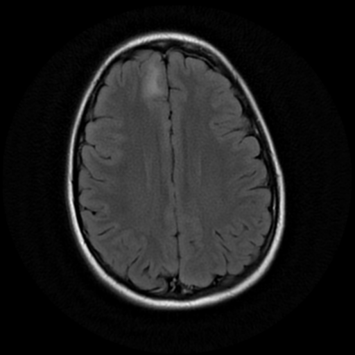 Oligodendroglioma NOS | Image | Radiopaedia.org