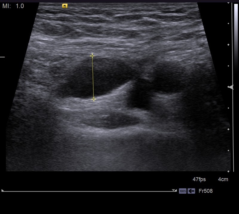 Hydrocele Of The Canal Of Nuck Image