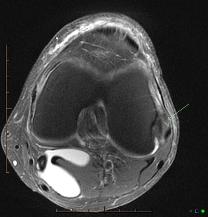 Tendinopathy | Radiology Reference Article | Radiopaedia.org