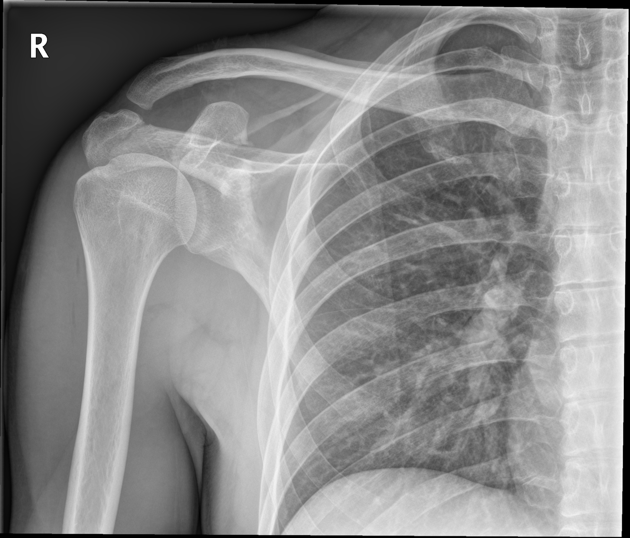 Coracoid process fracture | Image | Radiopaedia.org