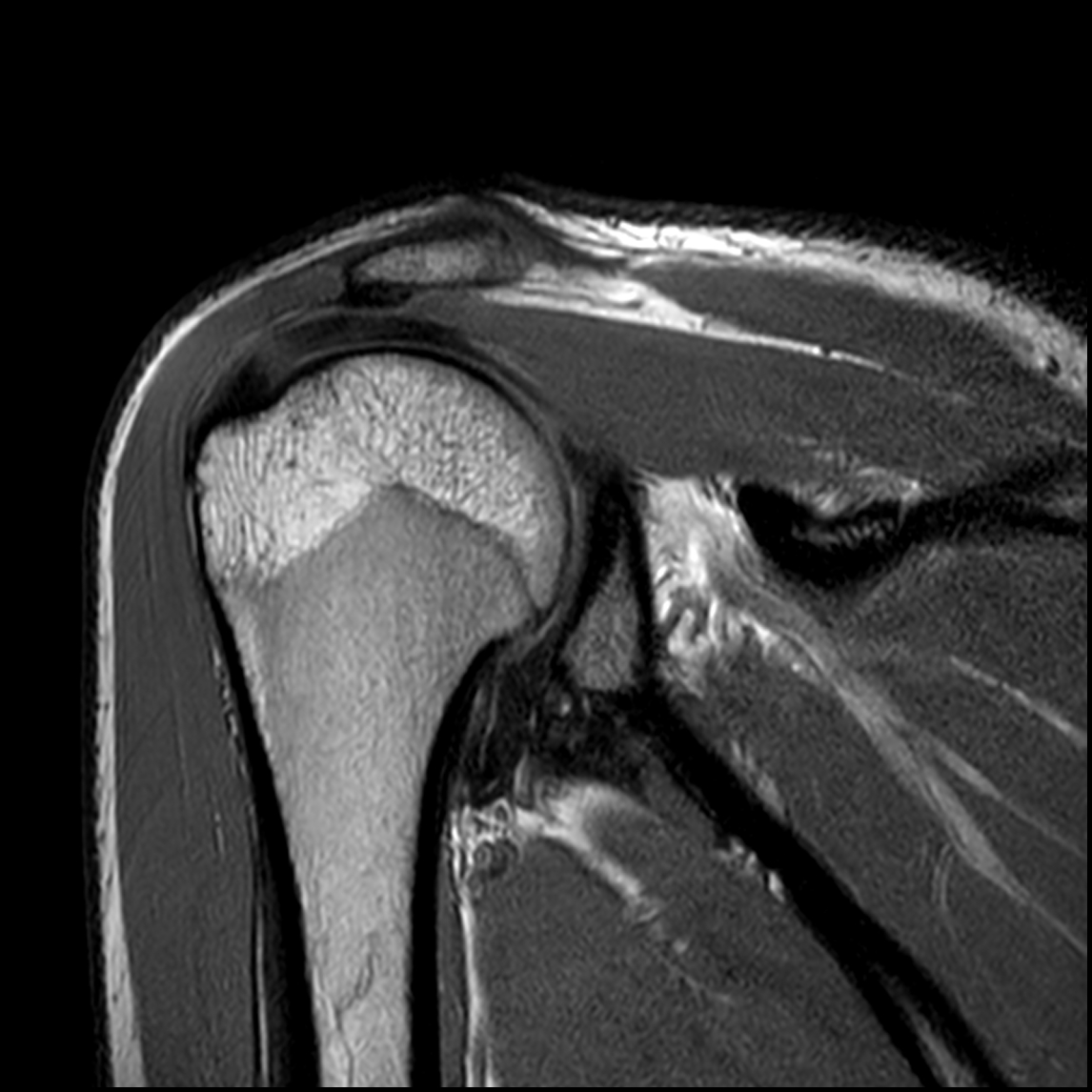 Кт плечевого сустава. Вывих плечевого сустава мрт. Мрт мягких тканей плечевого сустава. Артроз плечевого сустава мрт. Мрт плечевого сустава норма.