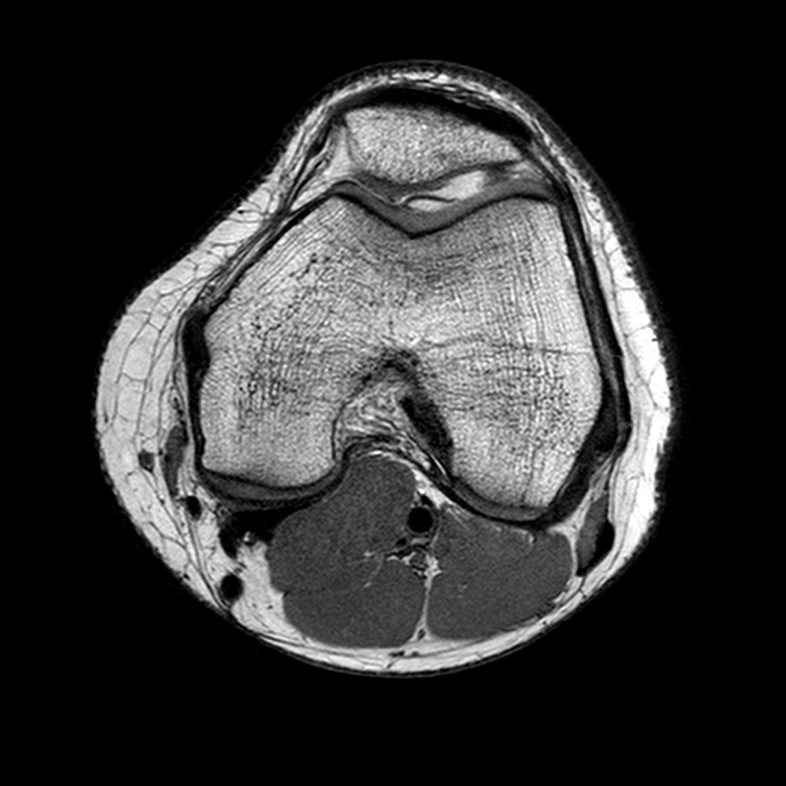 Mri Knee Axial