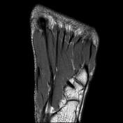 Abductor digiti minimi muscle (foot) | Radiology Reference Article