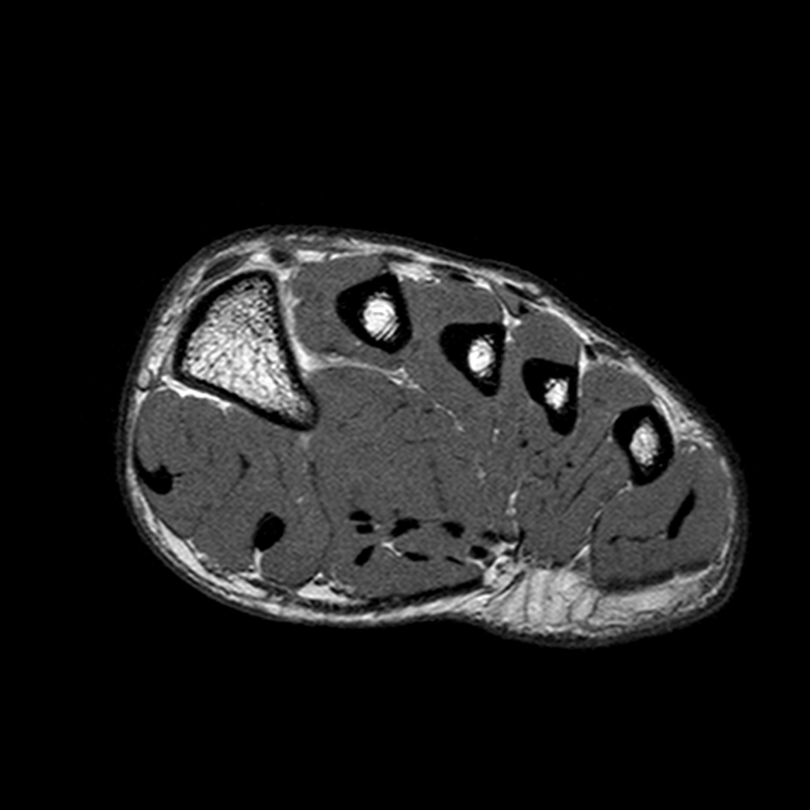 Normal Foot Mri Image