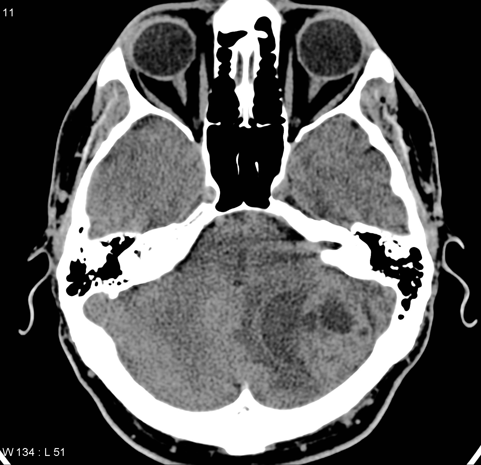 Medulloblastoma Symptoms