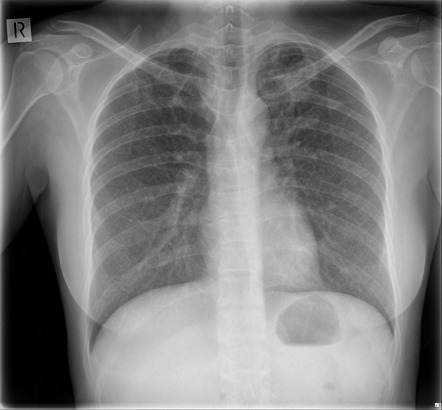 Miliary Tuberculosis 