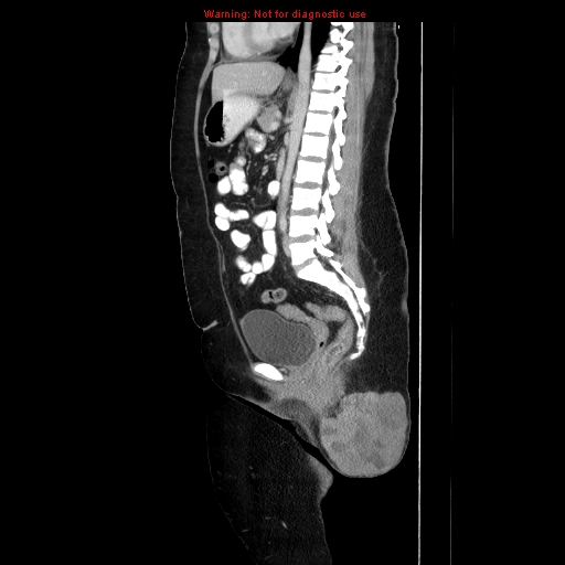 Extraosseous Ewing Sarcoma Image