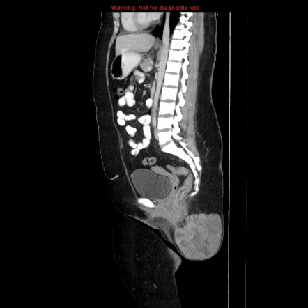 Extraosseous Ewing sarcoma | Radiology Case | Radiopaedia.org