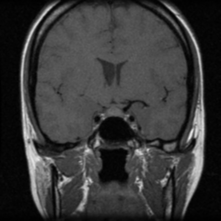 Craniospinal hypotension CSF leak | Image | Radiopaedia.org