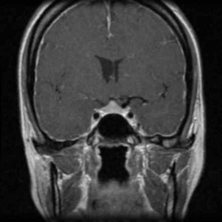 Craniospinal hypotension CSF leak | Image | Radiopaedia.org