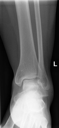 Talar fracture | Radiology Case | Radiopaedia.org