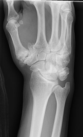 Lunate dislocation | Image | Radiopaedia.org