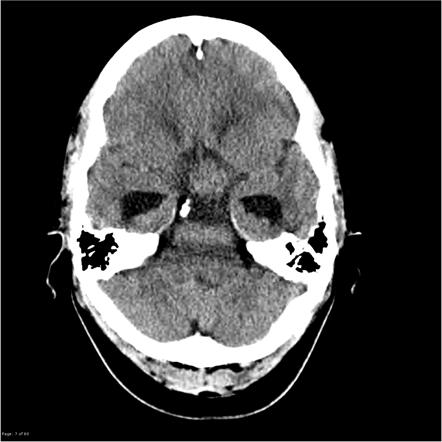 Teratoma - suprasellar | Radiology Case | Radiopaedia.org