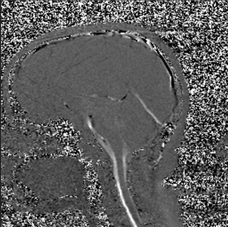 Obstructive Hydrocephalus Aqueductal Stenosis Image