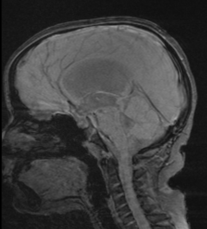 Obstructive Hydrocephalus Aqueductal Stenosis Image