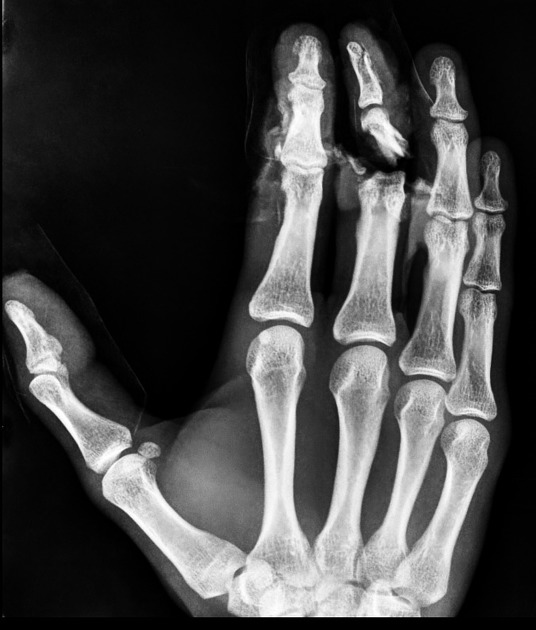 Middle phalanx fracture Radiology Reference Article