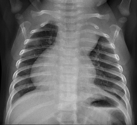 Double outlet right ventricle and dextrocardia | Radiology Case ...