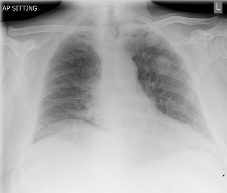 Left upper zone metastasis | Radiology Case | Radiopaedia.org