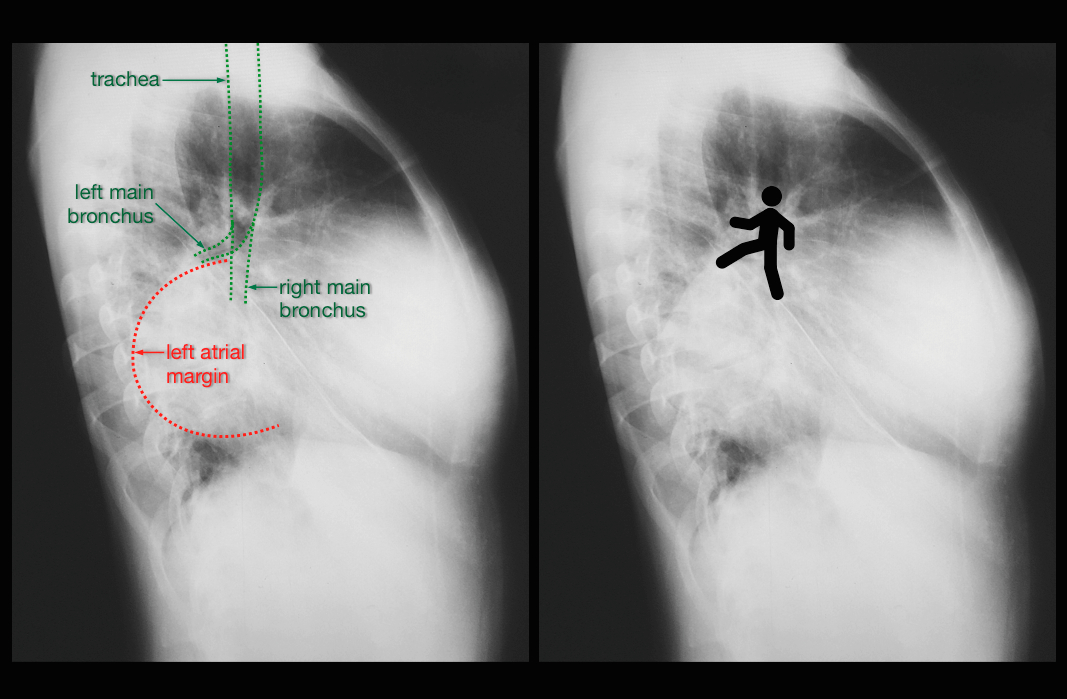 Left Atrial Enlargement Due To Mitral Valve Regurgitation Image