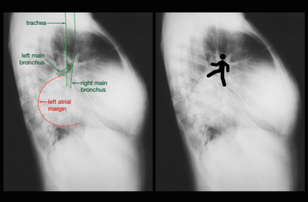 Walking Man Sign Chest X Ray Radiology Reference Article Radiopaedia Org